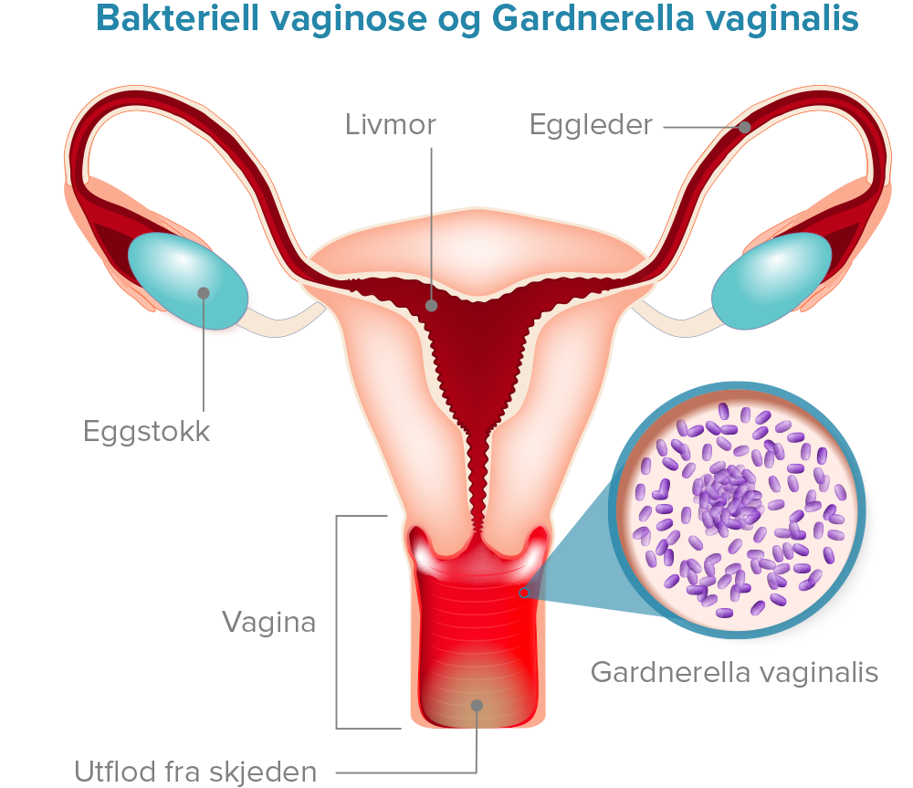 Bakteriell vaginose og Gardnerella Vaginalis Diagram.