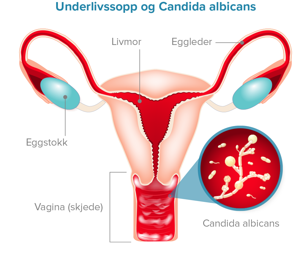 Underlivssopp og Candida albicans Diagram.